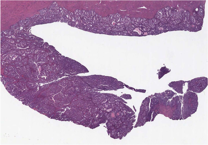 Endometroid Carcinoma