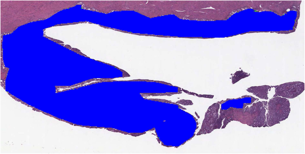 Detected endometrial Carcinoma tissue overlay
