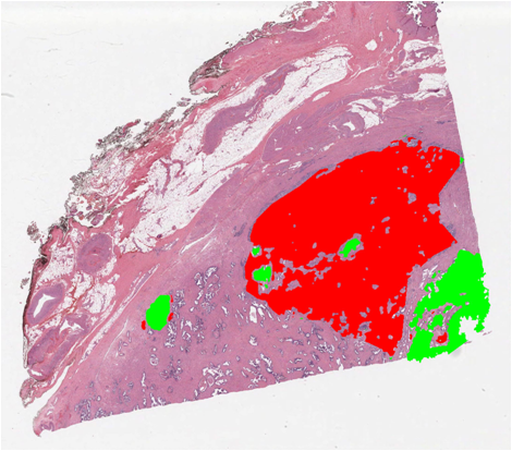 Identified and segmented (blue) Adenocarcinoma Carcinoma tissue