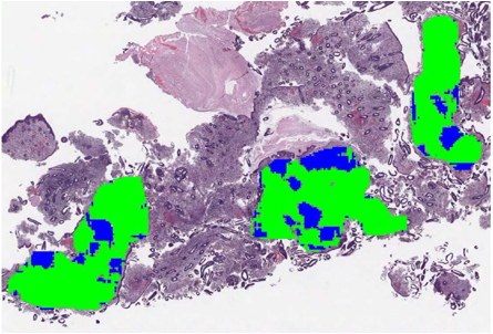 Proliferative Endometrium with Prediction Image on Top
